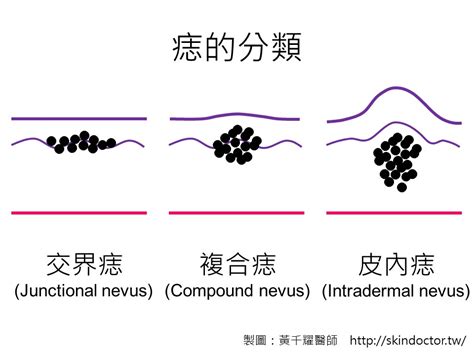 突出來的痣|痣為什麼會凸起來？醫師這樣說... 